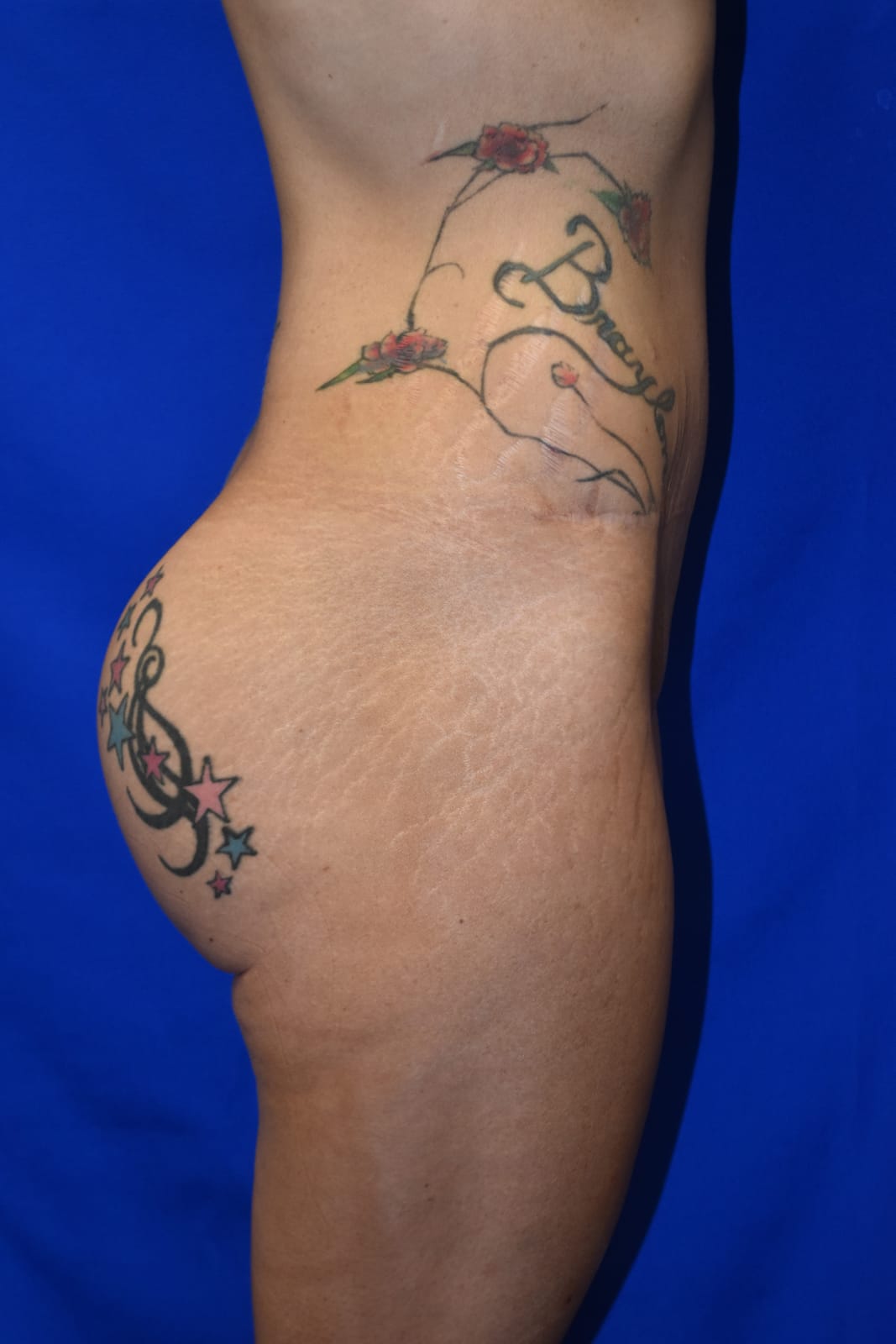 Case 1 Buttock Augmentation - Side view