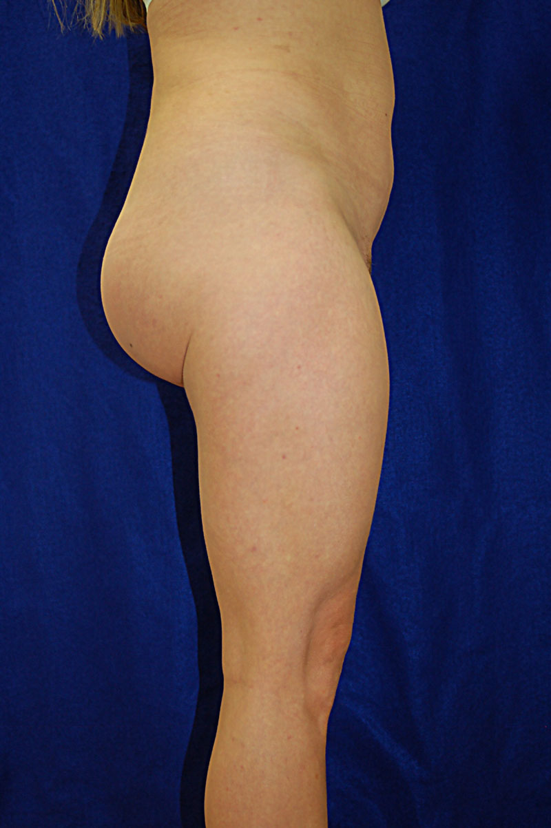 Case 2 Buttock Augmentation - Side view