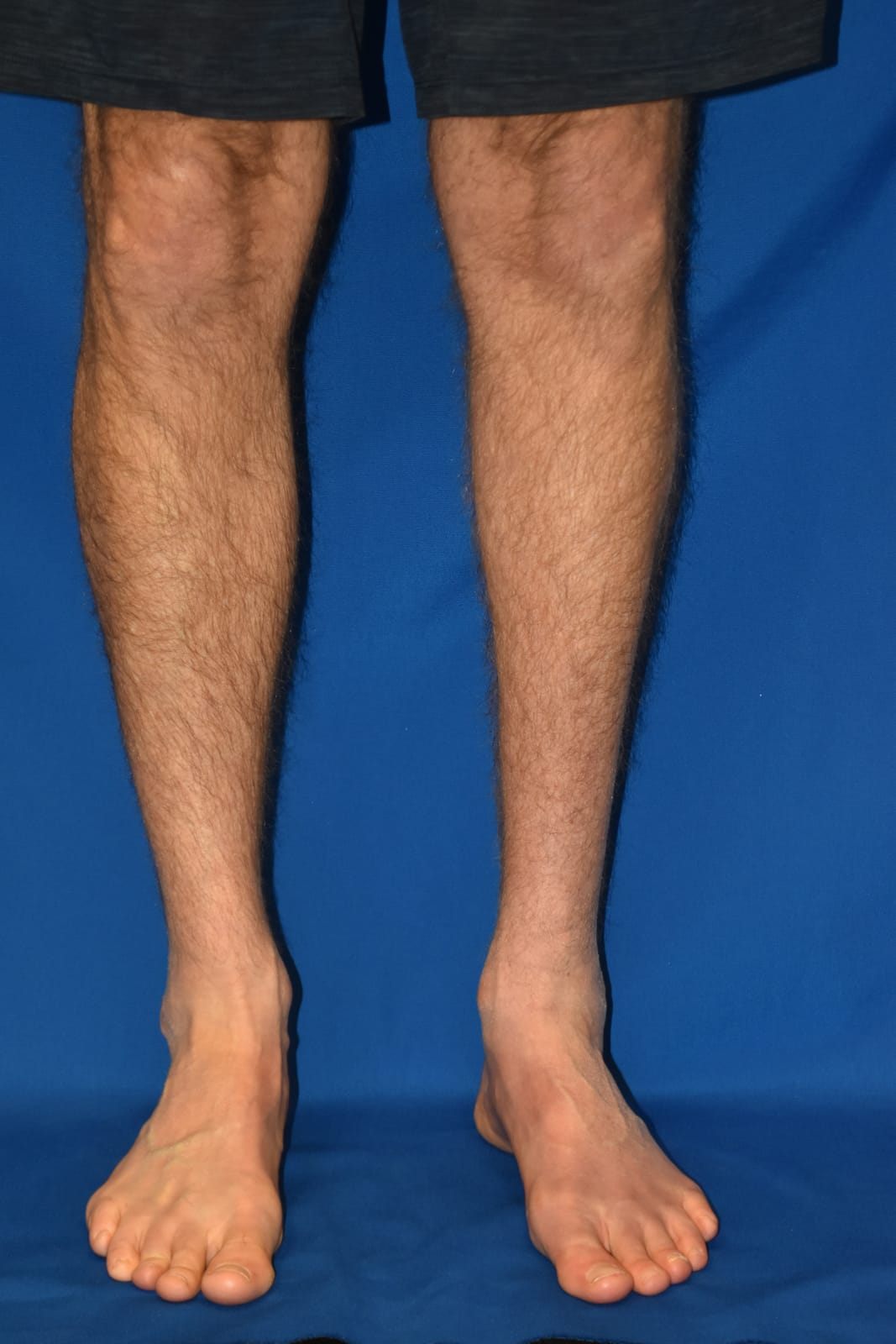 Case 1 Calf Augmentation - Front view
