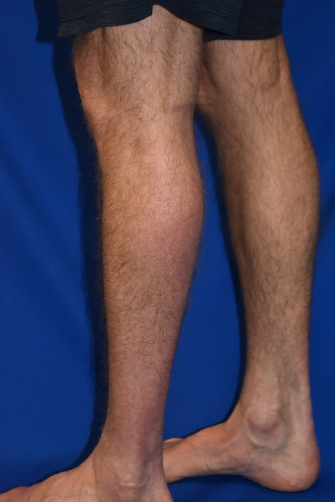 Case 1 Calf Augmentation - Side view