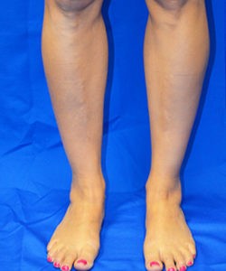 Case 2 Calf Augmentation - Front view