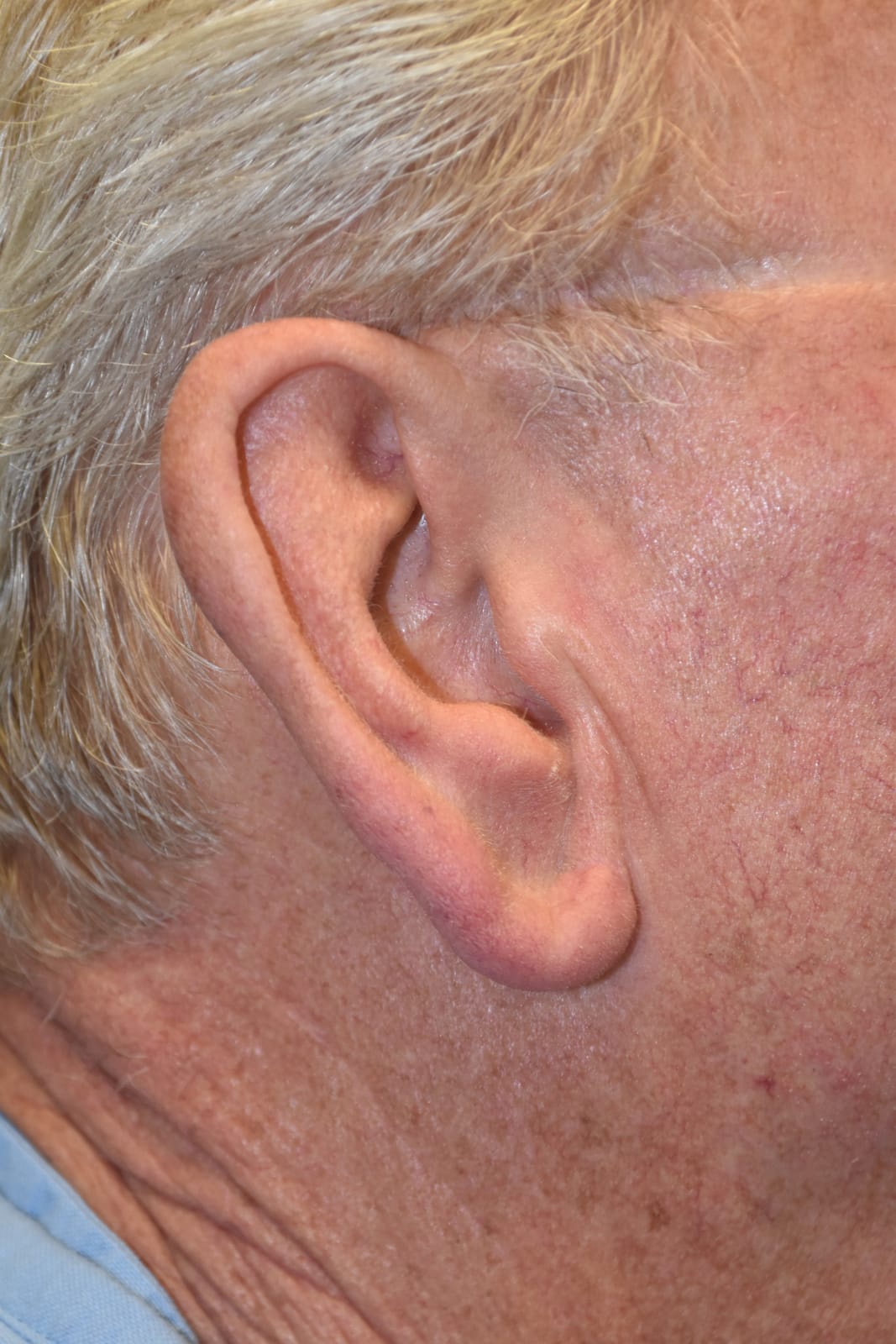 Case 1 Earlobe Reduction - Side view