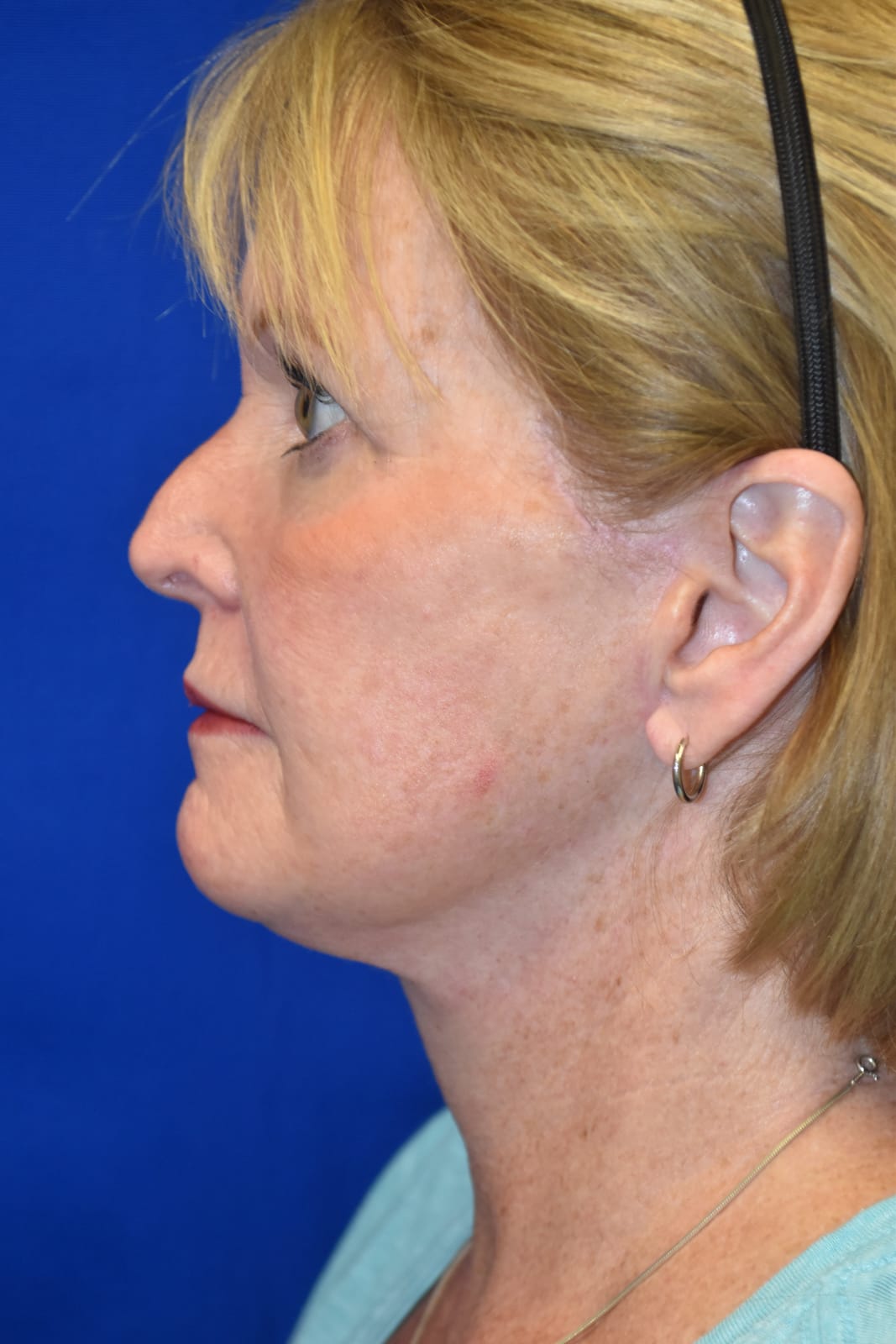 Case 1 Facelift - Left profile