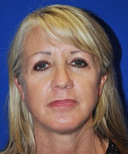 Case 10 Facelift - Angle 1