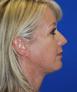 Case 10 Facelift - Angle 2
