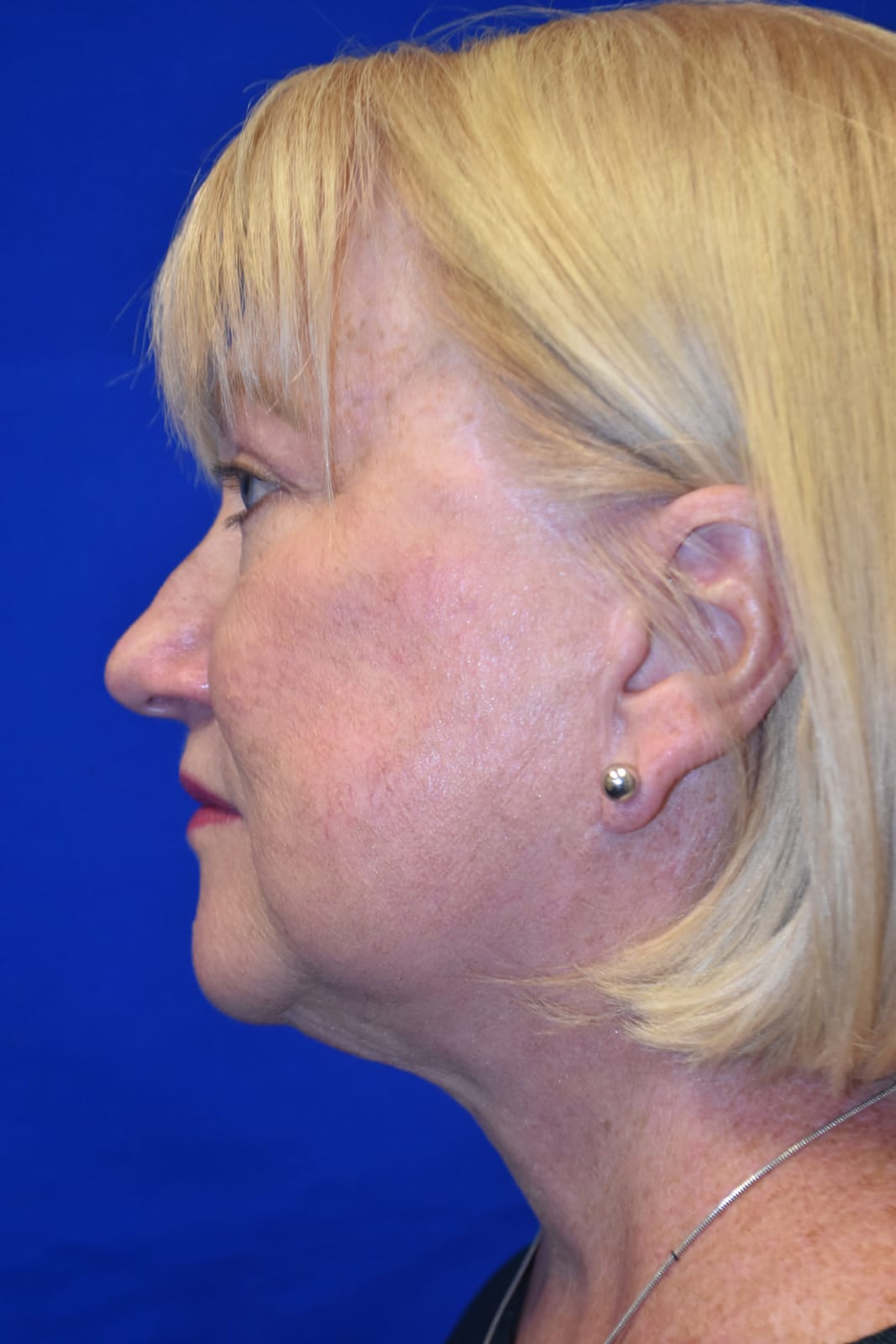 Case 2 Facelift - Side profile