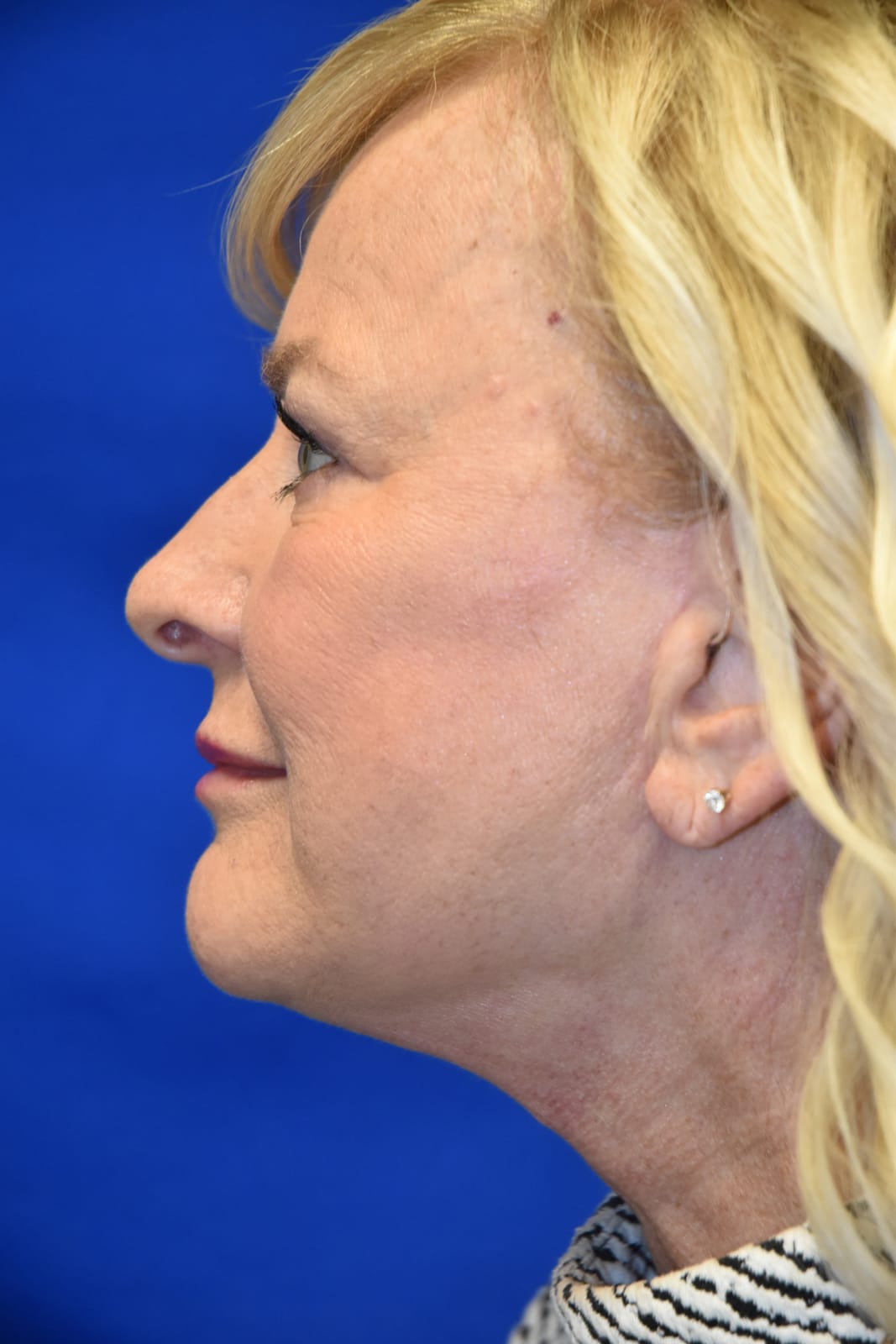 Case 3 Facelift - Right profile