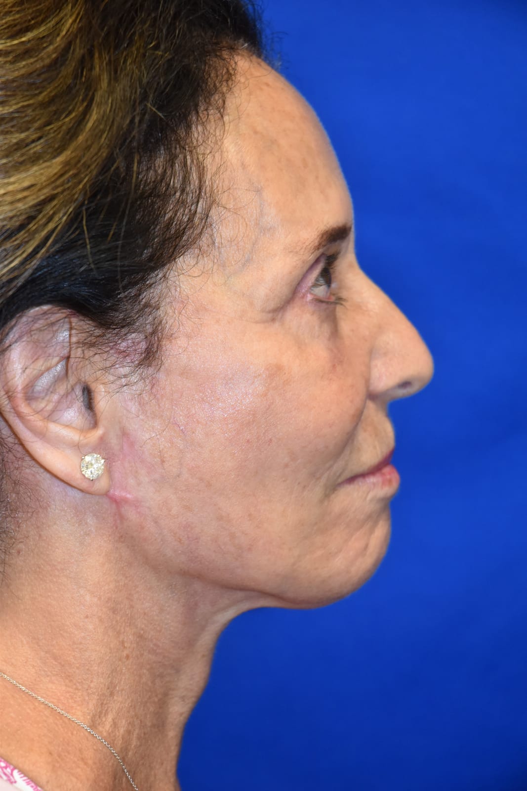 Case 4 Facelift - Side profile