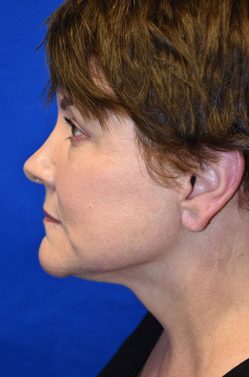 Case 5 Facelift - Right profile