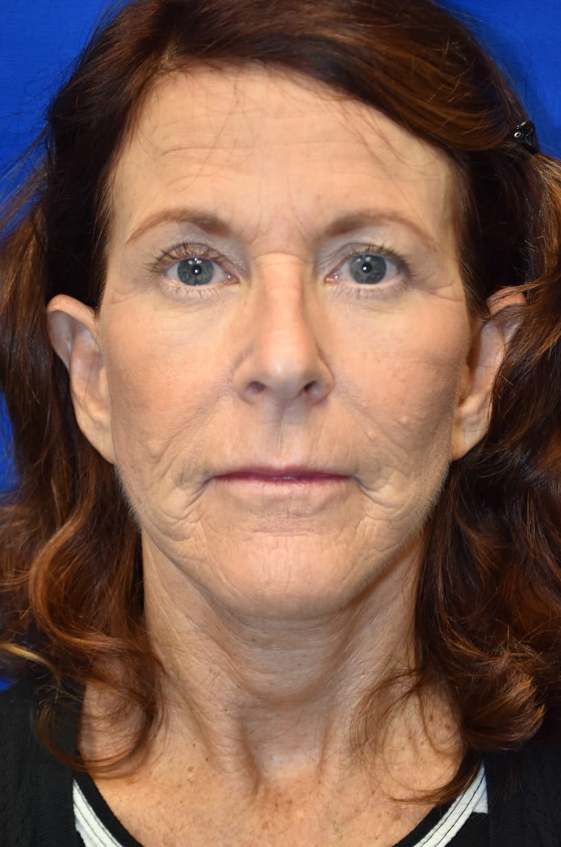 Case 8 Facelift - Front view