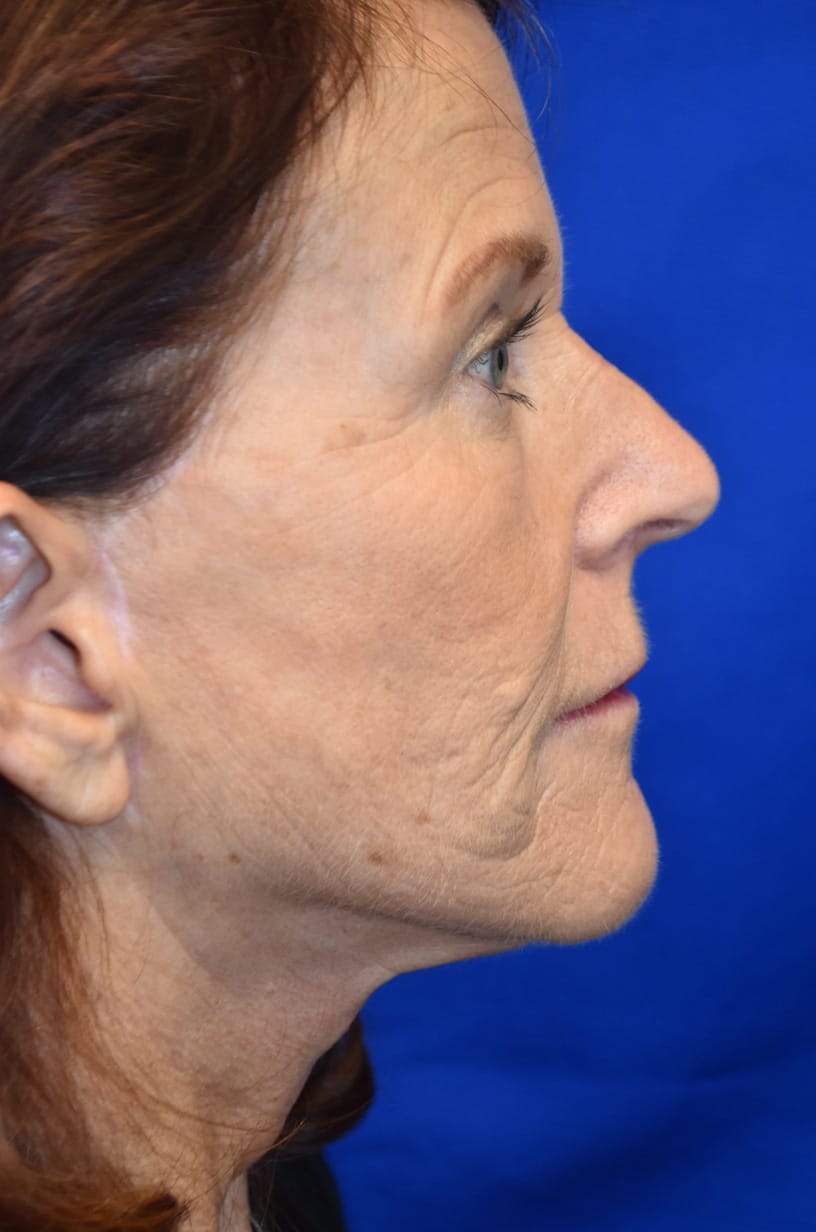 Case 8 Facelift - Side profile