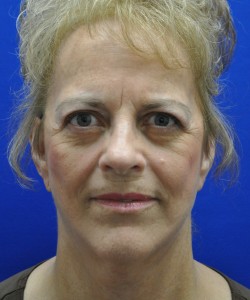Case 9 Facelift - Angle 1