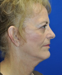 Case 9 Facelift - Angle 2
