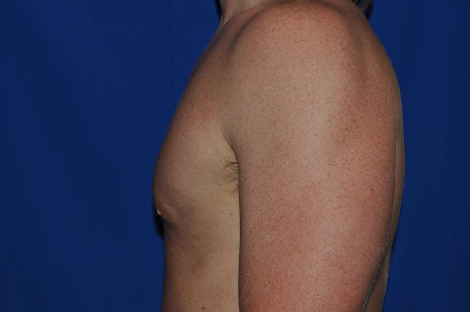Case 1 Gynecomastia - Side view