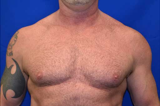 Case 2 Gynecomastia - Front view