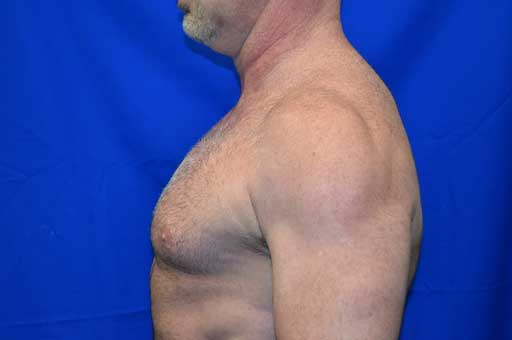 Case 2 Gynecomastia - Right side