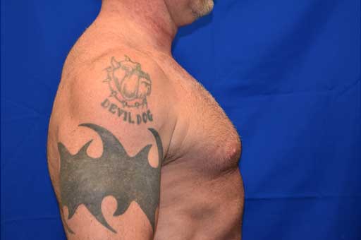 Case 2 Gynecomastia - Left side