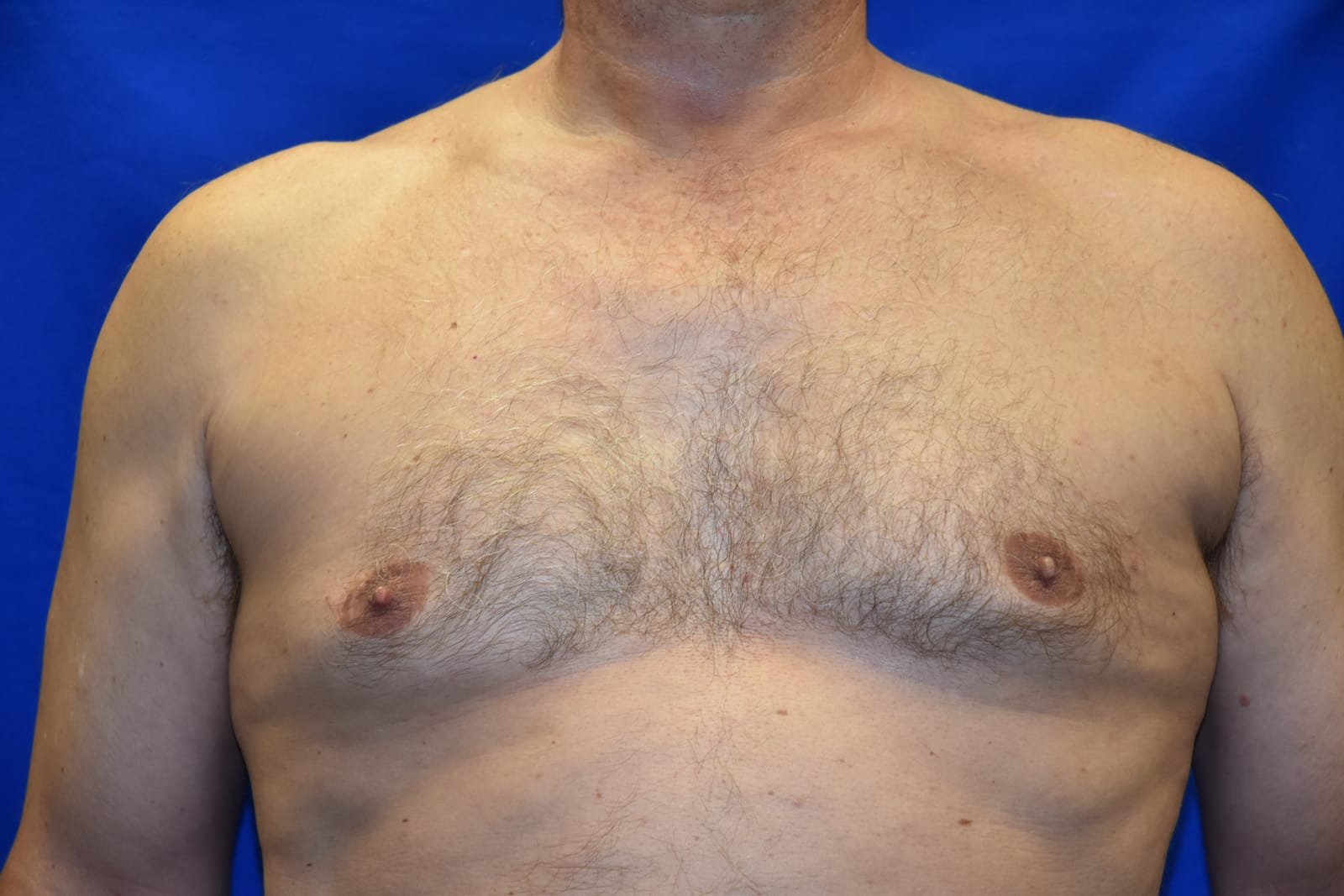 Case 3 Gynecomastia - Front view