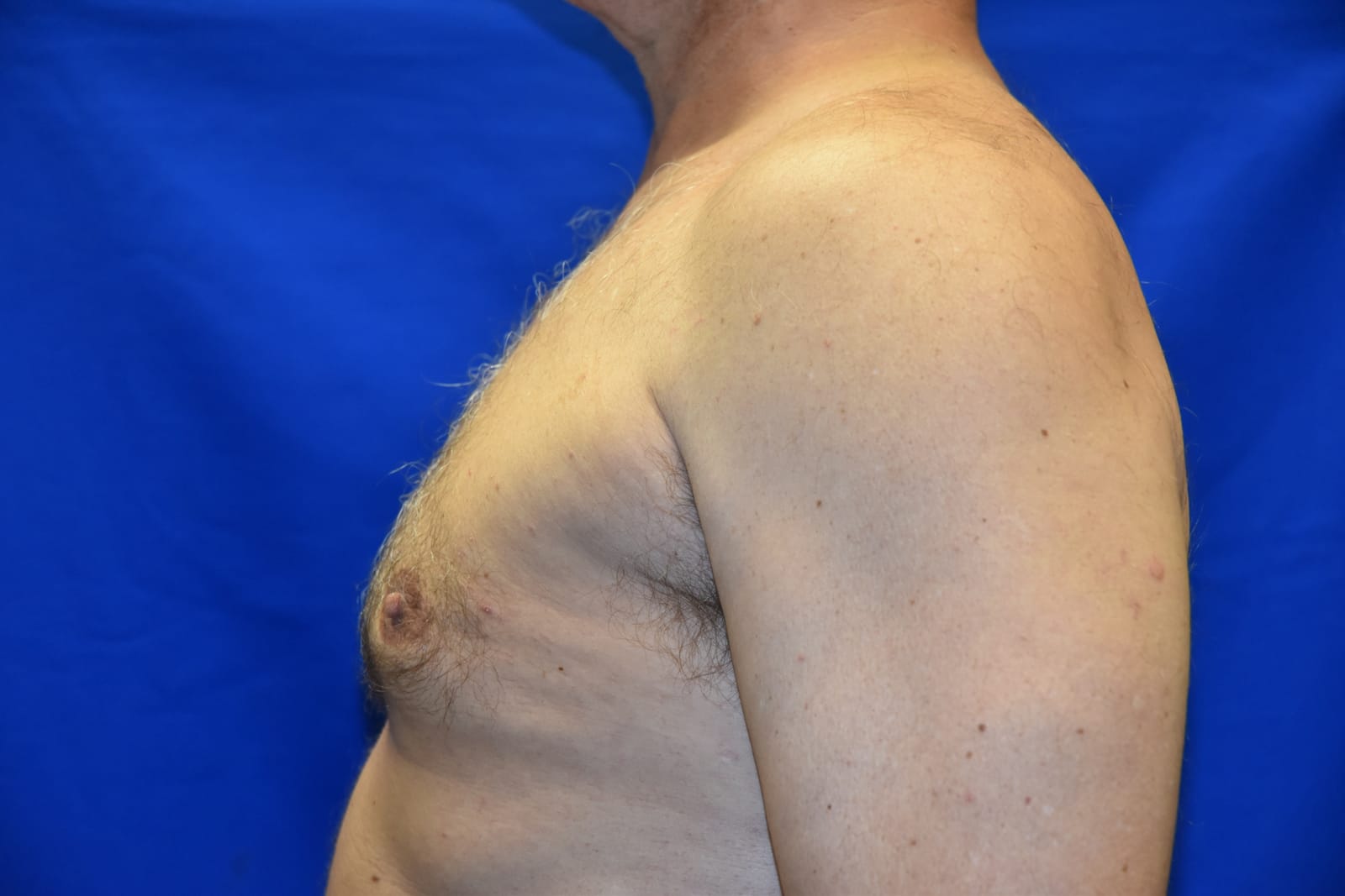 Case 3 Gynecomastia - Right side