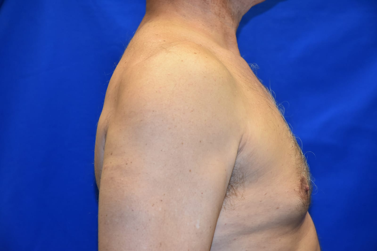 Case 3 Gynecomastia - Left side