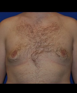 Case 4 Gynecomastia - Front view