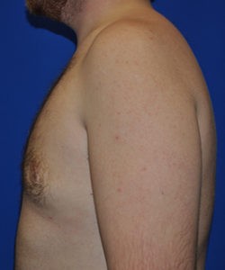 Case 4 Gynecomastia - Left side