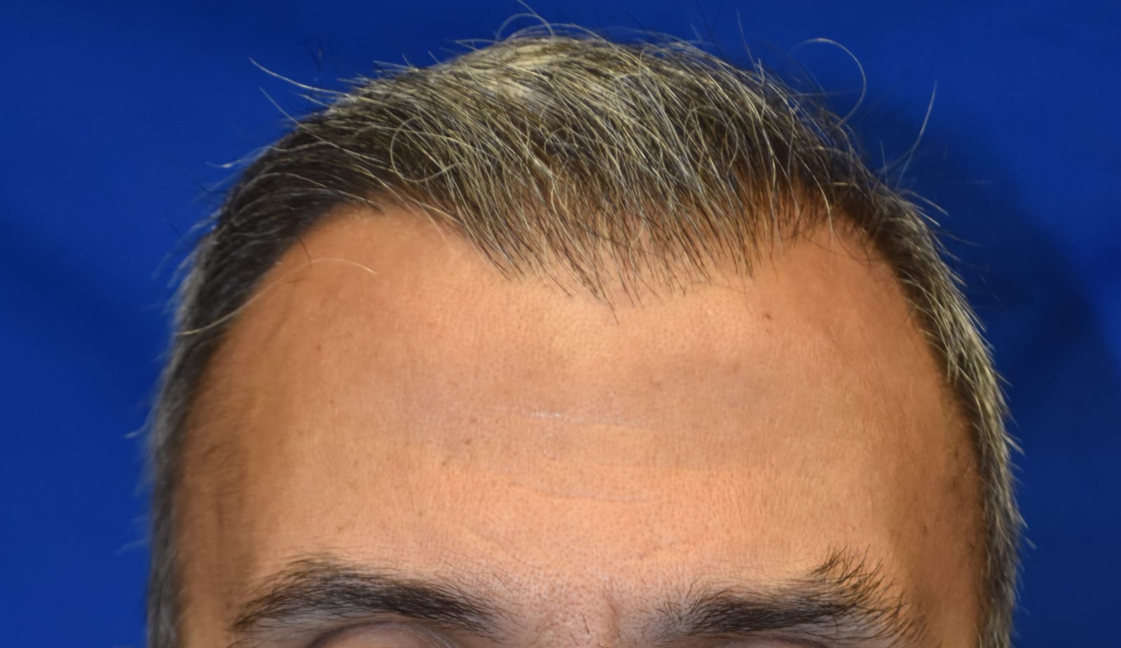 Case 1 Hair Transplant - Front view