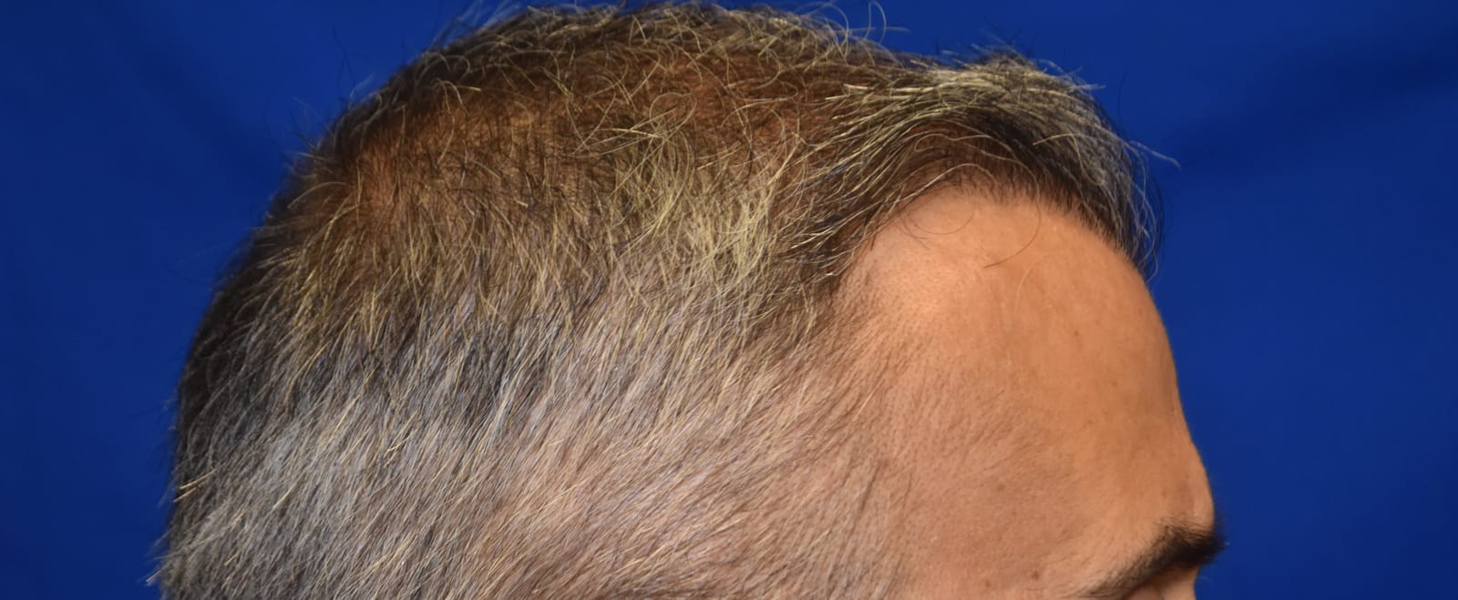 Case 1 Hair Transplant - Side view