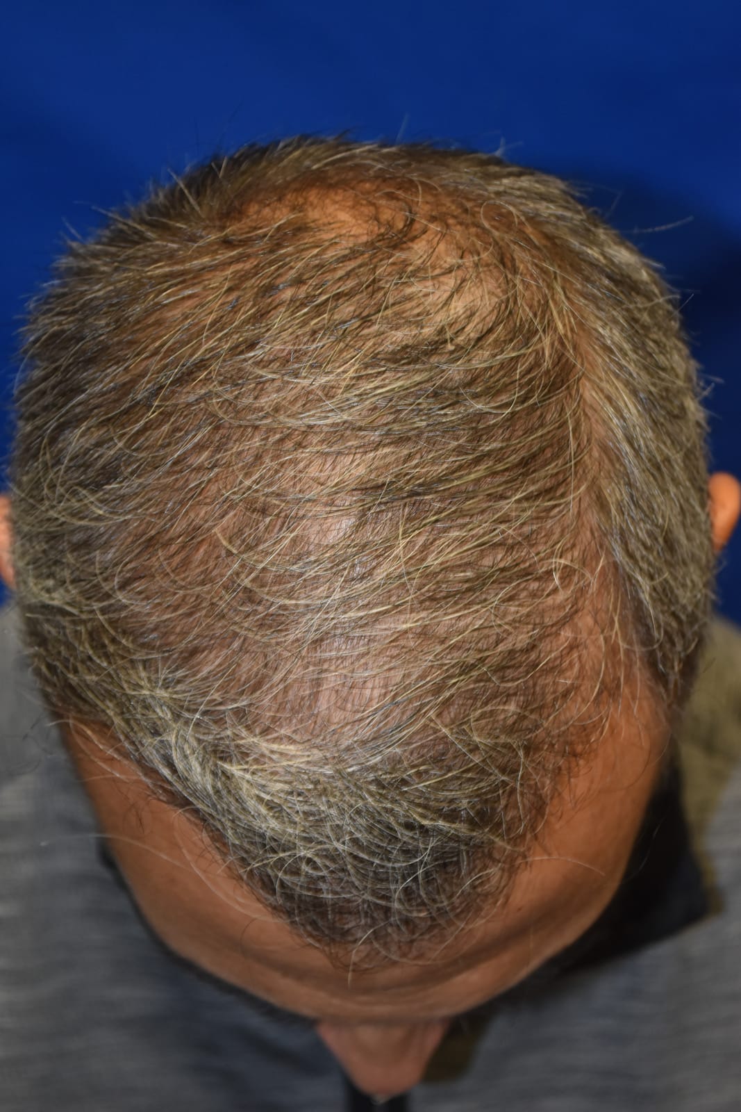 Case 1 Hair Transplant - Top view