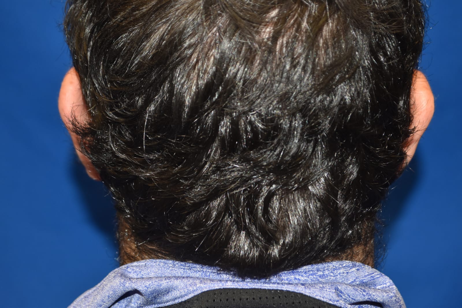Case 2 Hair Transplant - Back view