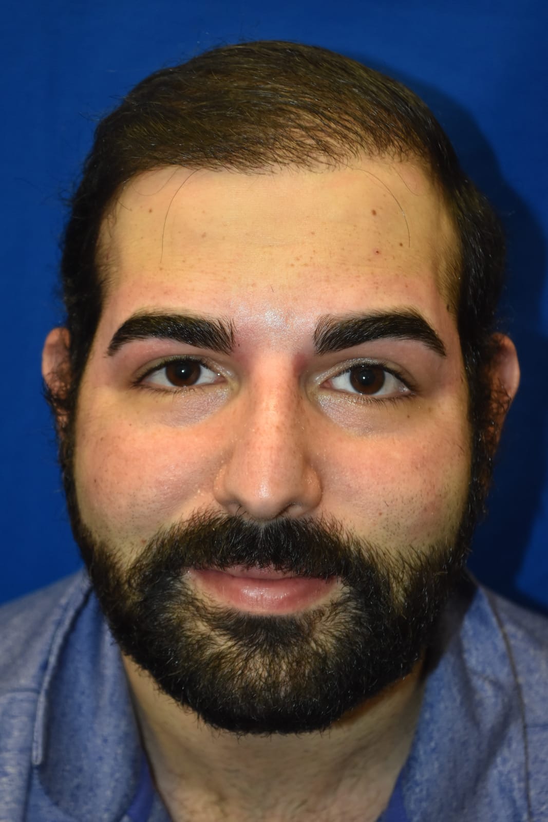Case 2 Hair Transplant - Front view