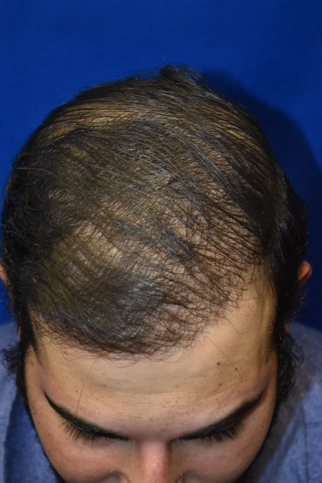 Case 2 Hair Transplant - Top view