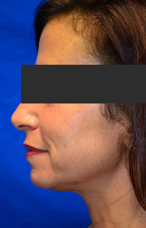 Case 1 Kybella - Side view