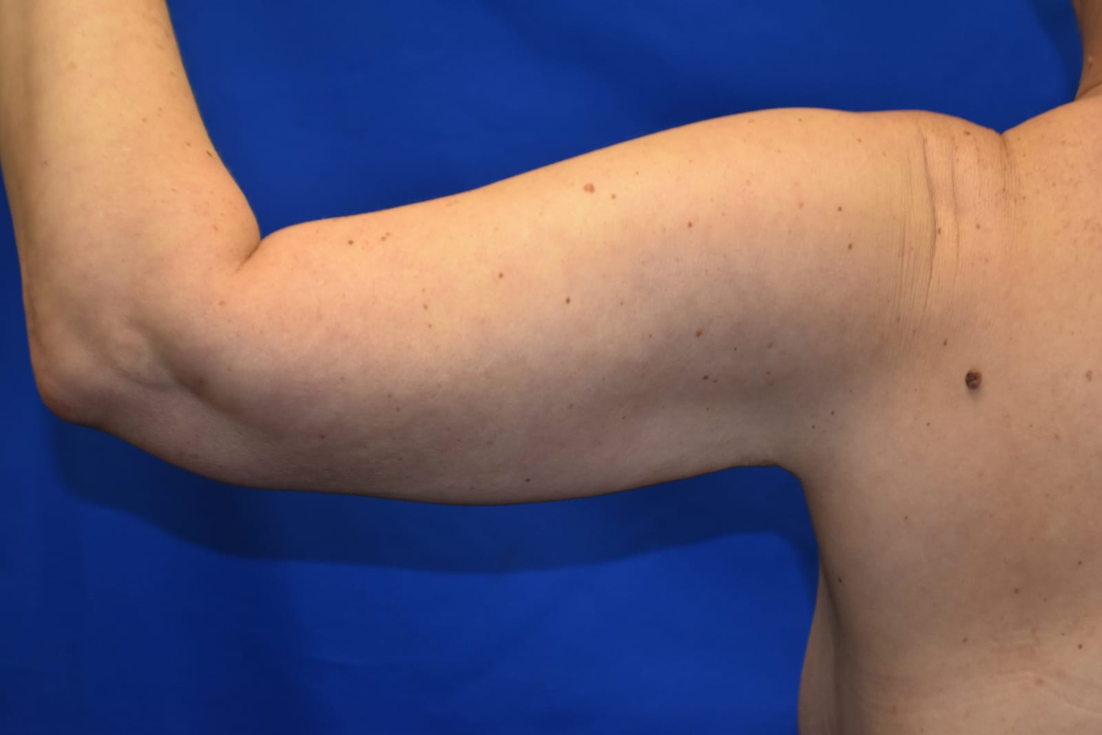 Case 1 — Arms Liposuction - Back view