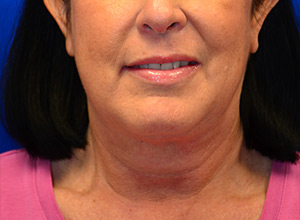 Case 10 — Neck Liposuction - Front view
