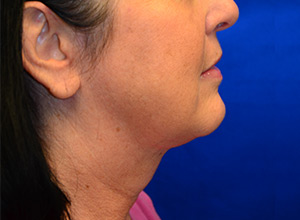 Case 10 — Neck Liposuction - Side view