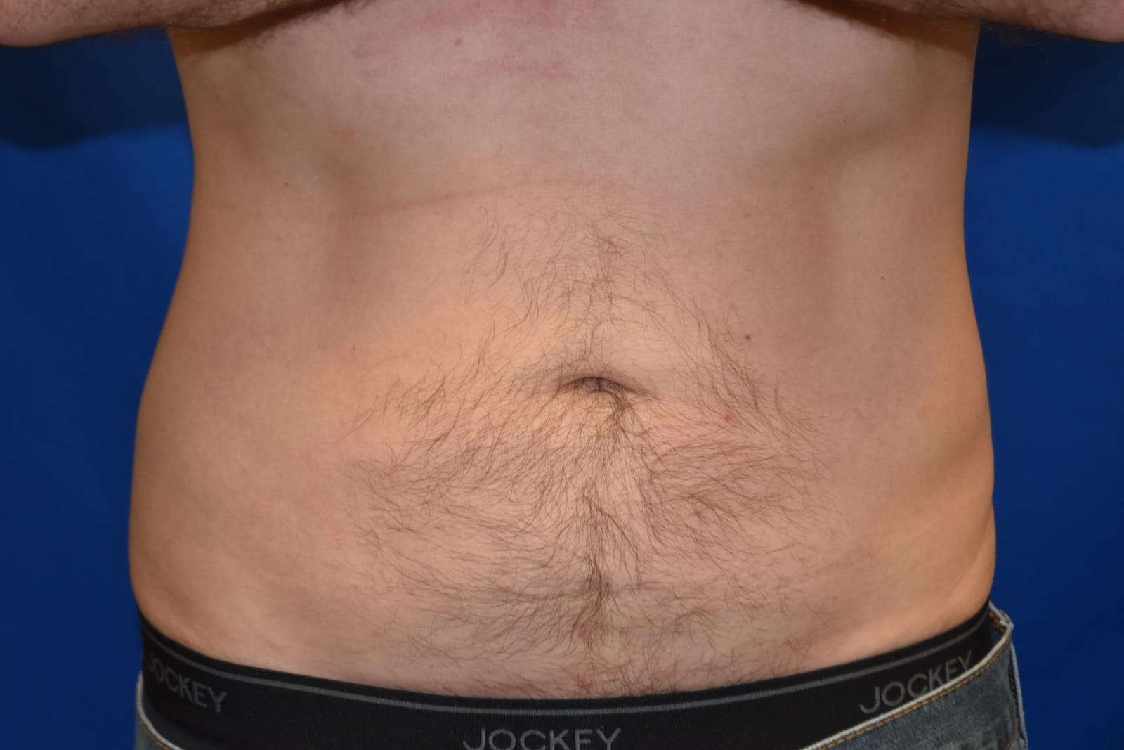 Case 2 — Abdomen Liposuction - Front view