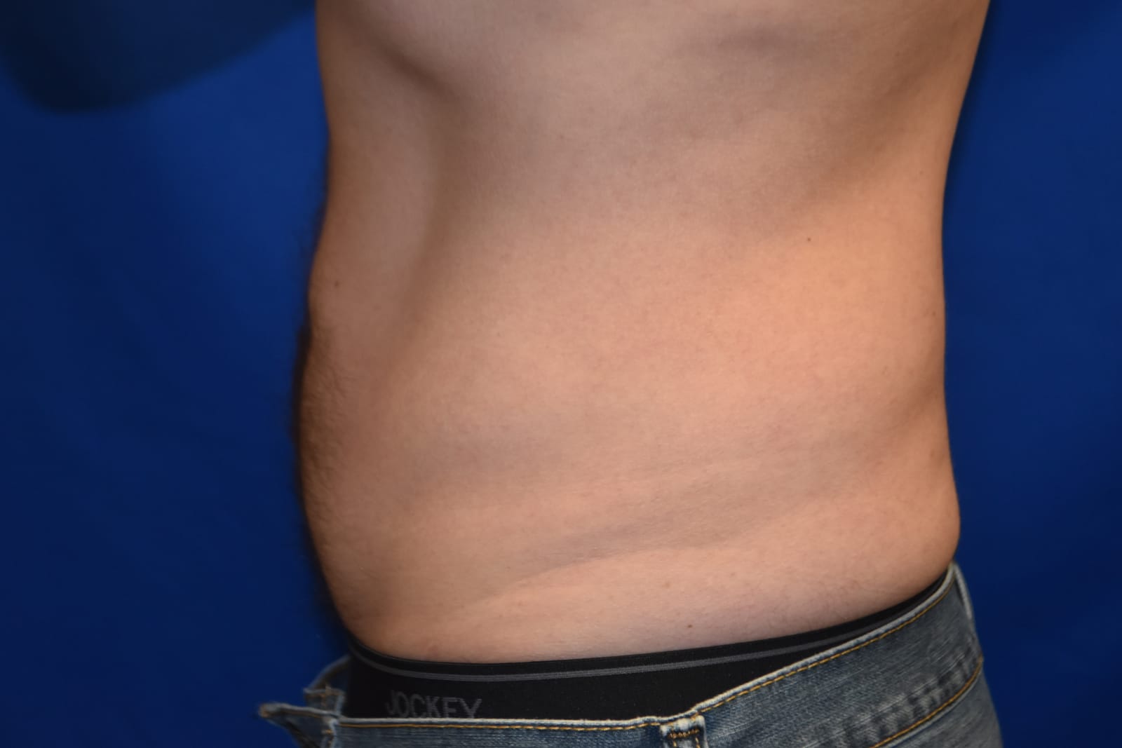Case 2 — Abdomen Liposuction - Side view