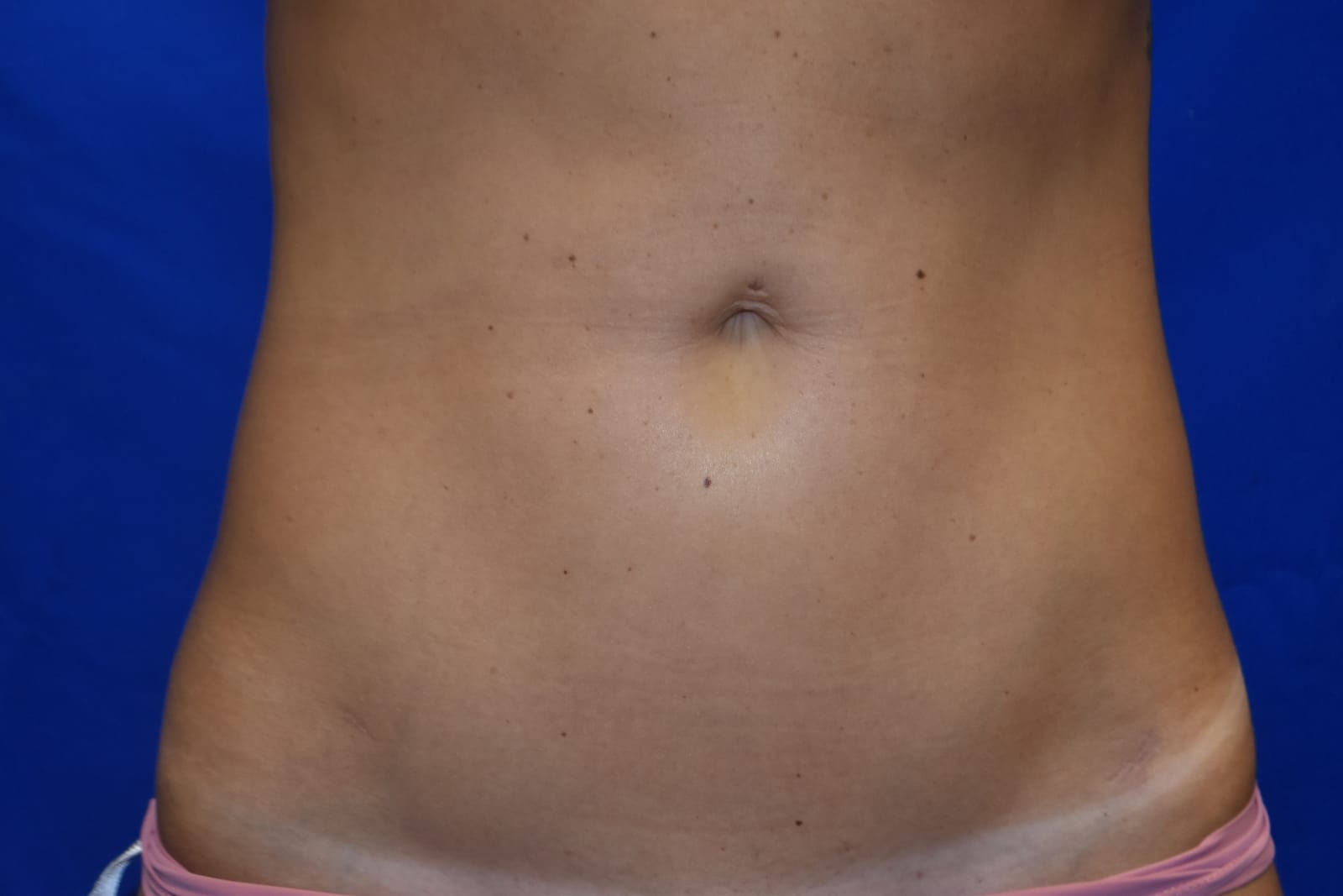 Case 3 — Abdomen Liposuction - Front view