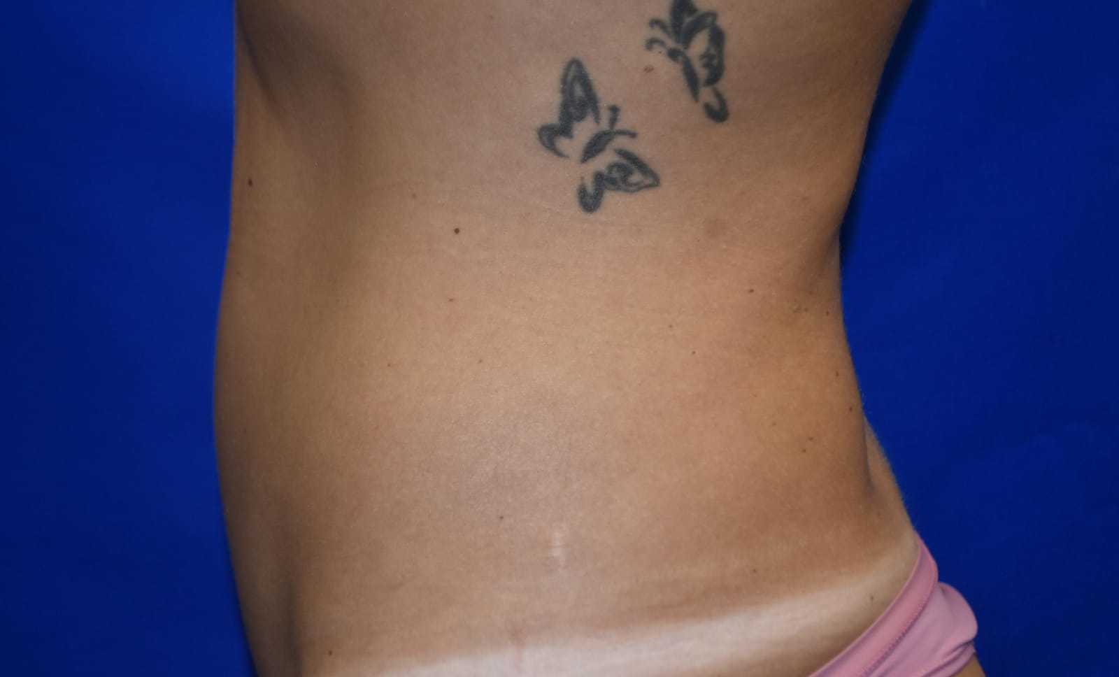 Case 3 — Abdomen Liposuction - Side view