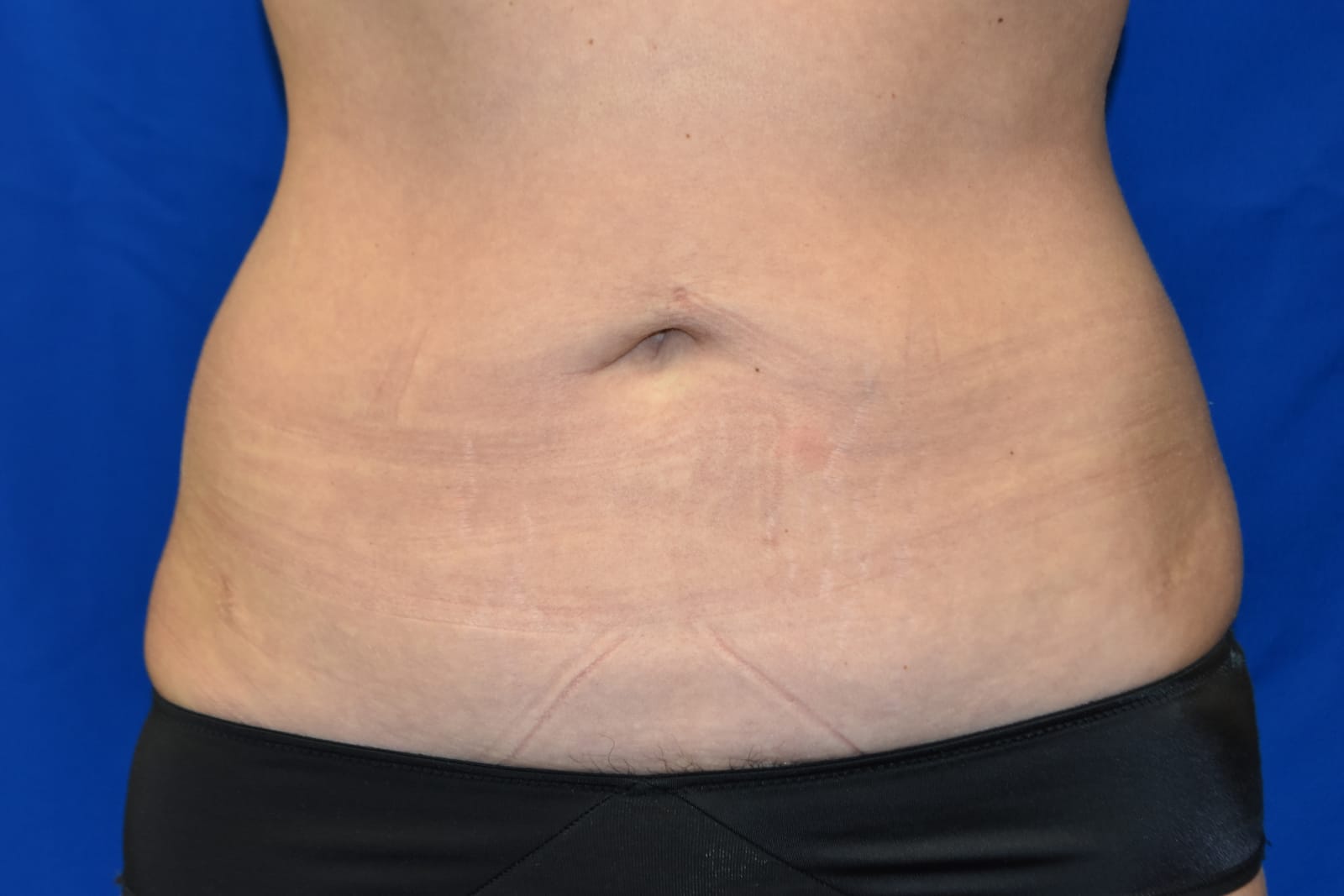 Case 4 — Abdomen & Flanks Liposuction - Front view