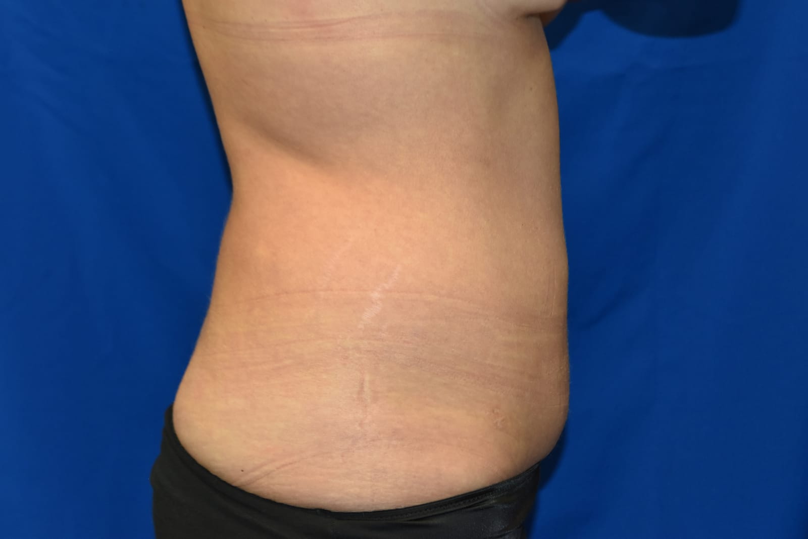 Case 4 — Abdomen & Flanks Liposuction - Side view