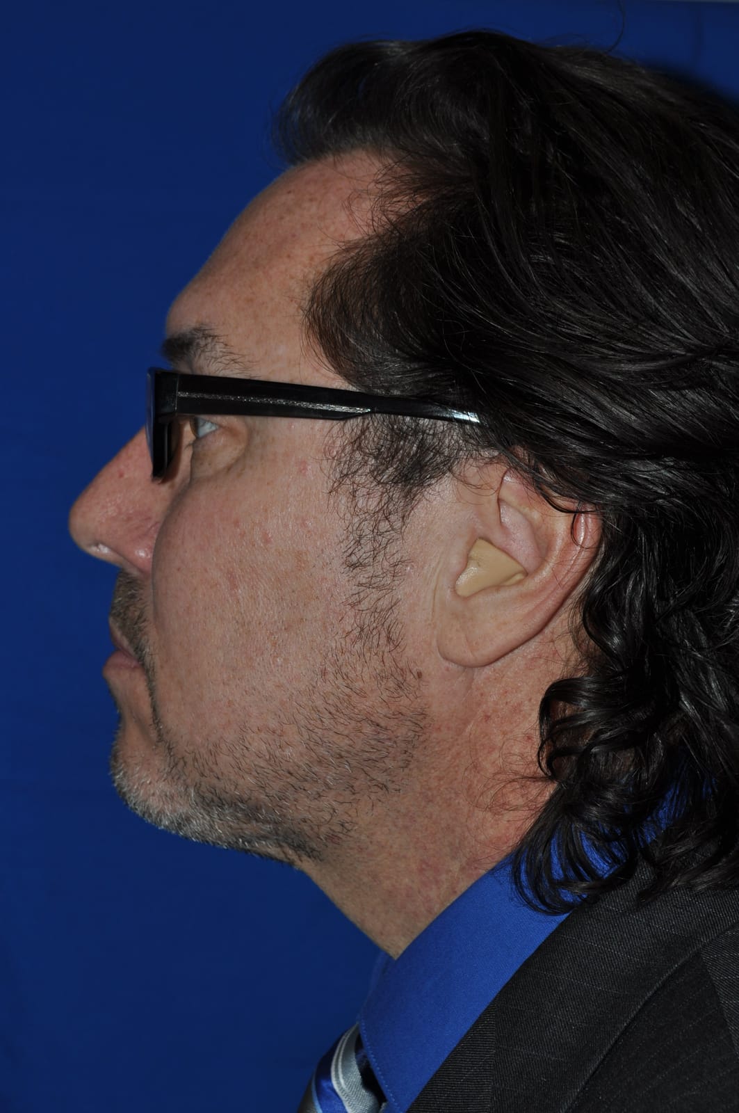 Case 5 — Neck Liposuction - Side view
