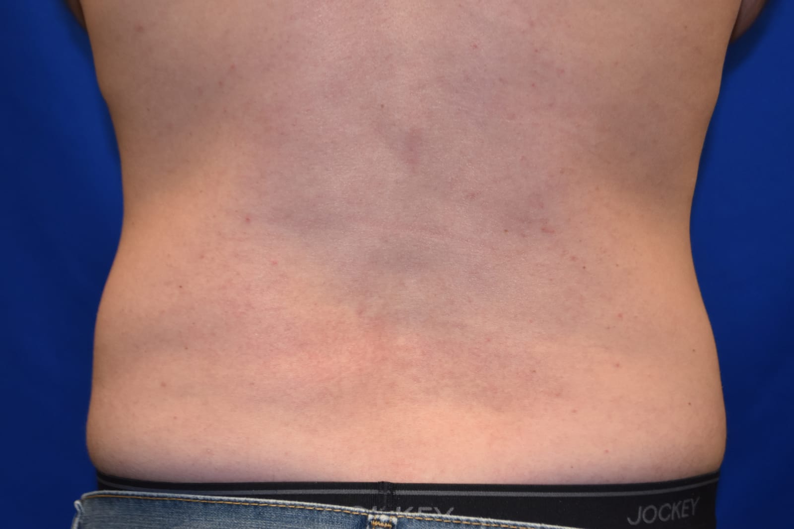 Case 6 — Flanks Liposuction - Back view