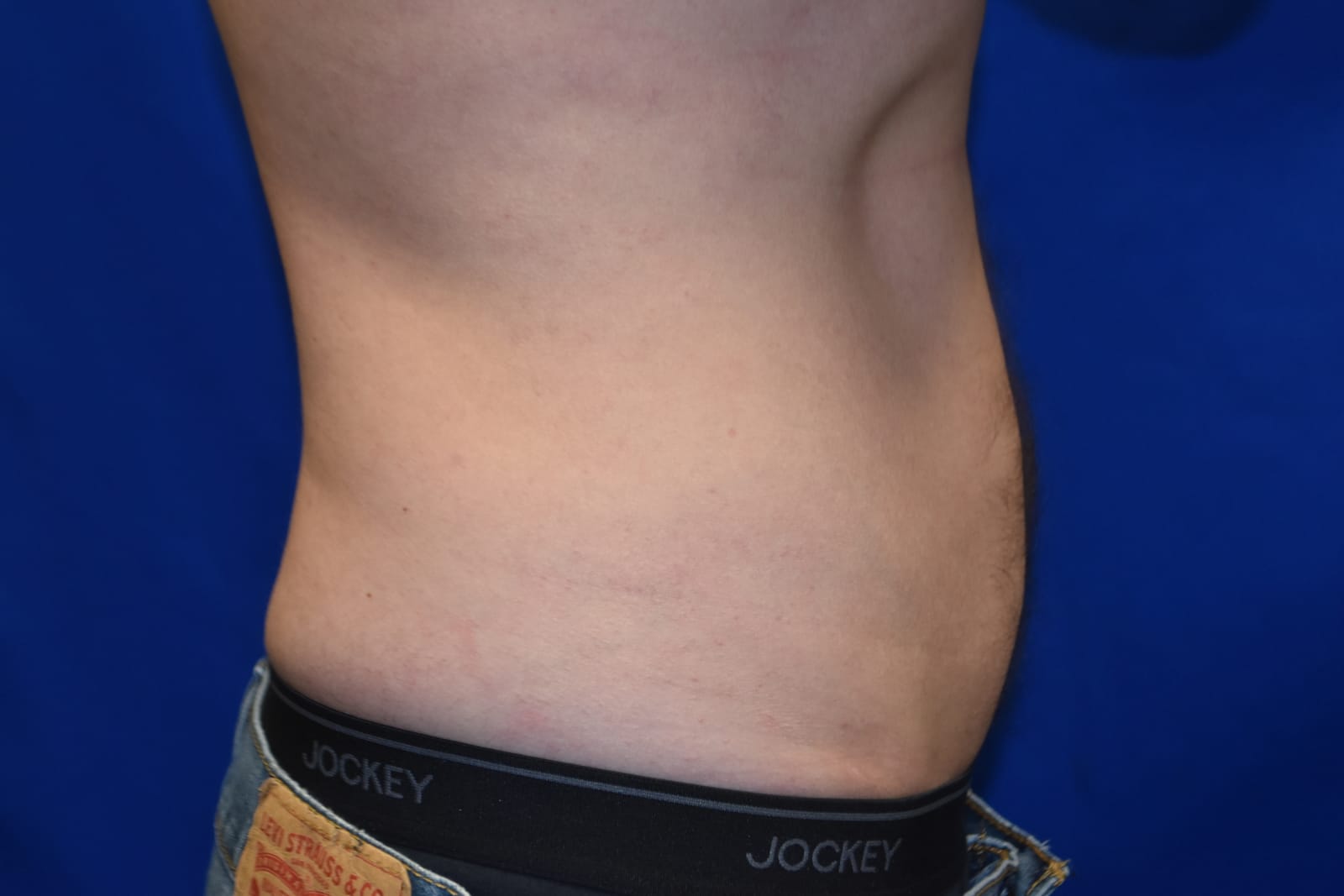 Case 6 — Flanks Liposuction - Side view