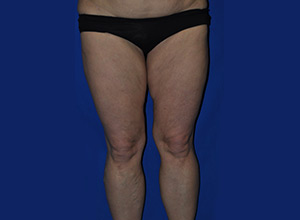 Case 7 — Abdomen Liposuction - Front view