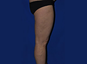Case 7 — Abdomen Liposuction - Side view