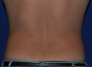 Case 8 — Abdomen Liposuction - Back view