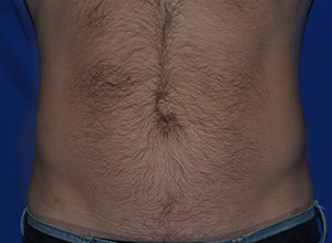 Case 8 — Abdomen Liposuction - Front view