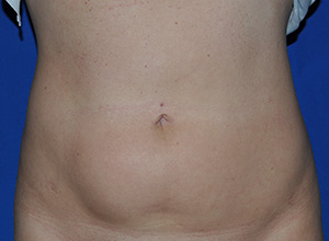 Case 9 — Abdomen Liposuction - Front view